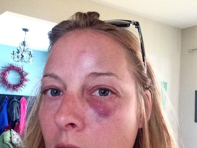 Megan Rieke was left bruised after a run-in with an angry Crestwood cop, her lawyer says.