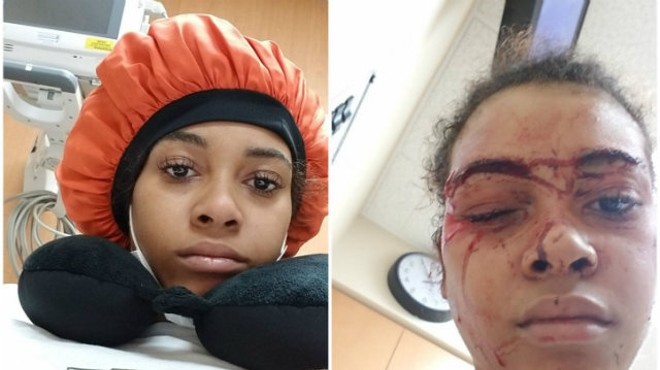 Vanity Allen before (left) and after her lawyer says she was struck by a security guard.