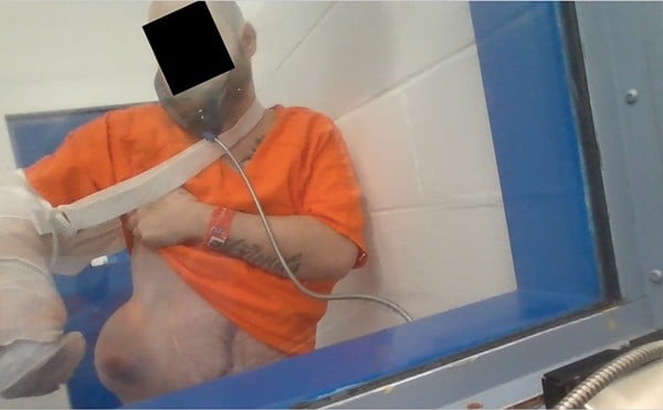 A CJC detainee shows a large hernia that his family says went long-untreated in the jail.