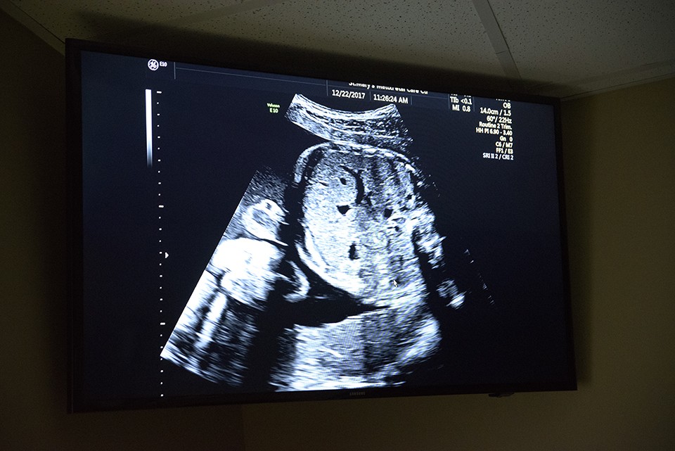 A screen shows Clemens' ultrasound at the WISH Center. - NICK SCHNELLE