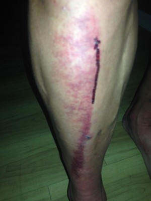 A close-up of Randy Murdick's injured right leg. - Courtesy Randy Murdick