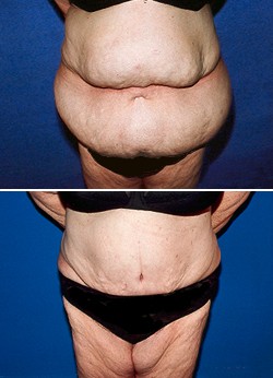 Number 5: Dr. Joy of Long Beach, CA, will happily remove your pannus. - www.plasticare.com