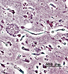 Amyloid plaque, an earlier harbinger of Alzheimer's. - image via