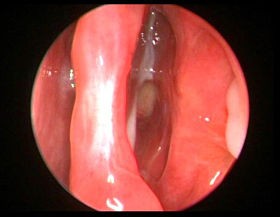 Pus draining from an infected sinus. Who knew something so little could hurt so much? - image via