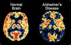 Study Shows Family, Friends Better Than Doctors at Detecting Early Signs of Alzheimer's