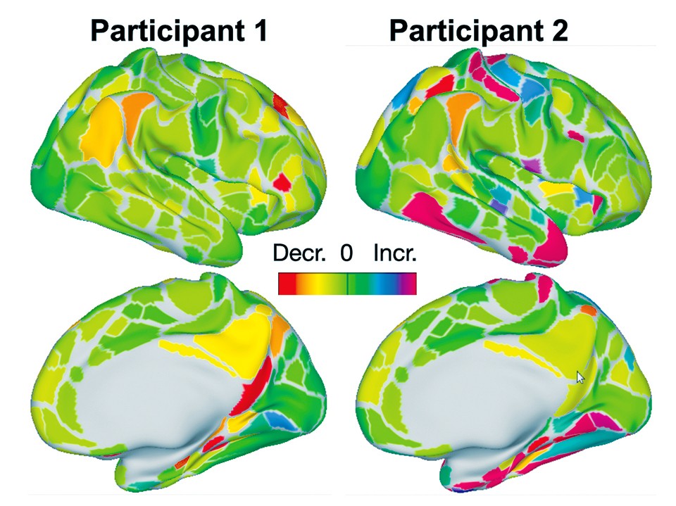 Brain scan images show neural activity from two subjects after taking a “large dose” of psilocybin in a Washington University study. - JOSHUA SIEGEL